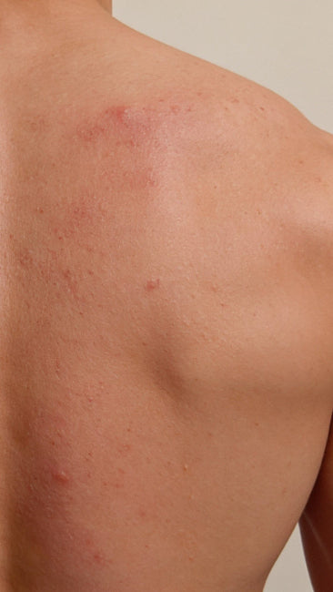 Back view of a person's upper back and shoulders showing skin with red acne or blemishes, against a plain light beige background.